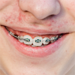 Brace Removal